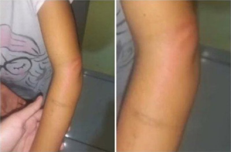 Mãe é presa após fraturar braço da filha de 5 anos a madeiradas